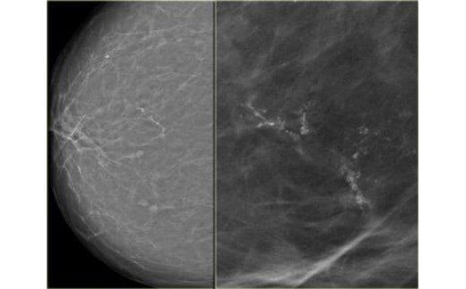 マンモグラフィー＋乳房エコー検査